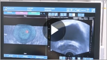 4. 前立腺癌に対するMRI/US fusion-guided biopsy 検査の流れ : 標的生検手技